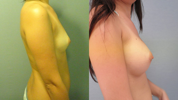 breast-augmentation-case