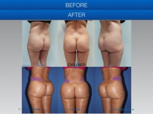 UK specialists buttock augmentation