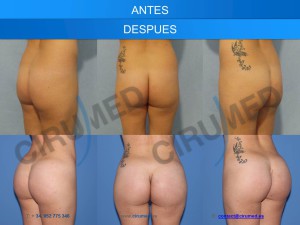 buttock implants case of the month 2017